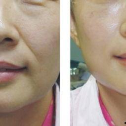 怎样去除法令纹视频,视频教程揭秘高效护肤秘诀